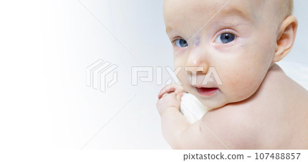 a baby with a hemangioma on his neck lies on a white background a baby with a hemangioma on his neck lies on a white background 107488857