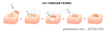 Endoscopy ESD Endoscopic submucosal dissection 107521783