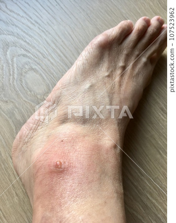 被蟲咬了紅腫流膿 被蟲咬了紅腫流膿 107523962