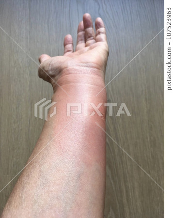 Insect bite redness and swelling Insect bite redness and swelling 107523963