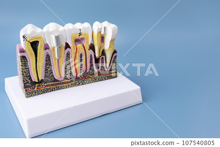 Dental Tooth Bridge Or Implant Model On Blue Background, Copy Space For Text. Dummy Mockup Human Jaw Oral Dentures. Prosthesis On Metal Peg. Horizontal Plane 107540805