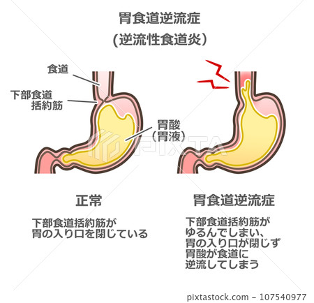 Illustration of gastroesophageal reflux disease Illustration of gastroesophageal reflux disease 107540977