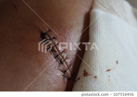 wound wound 107558456