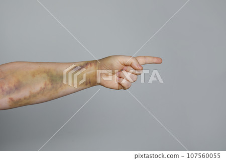 Female hand with issues bruise pointing at abuser, blaming and accusing. Domestic violence and abuse Female hand with issues bruise pointing at abuser, blaming and accusing. Domestic violence and abuse 107560055