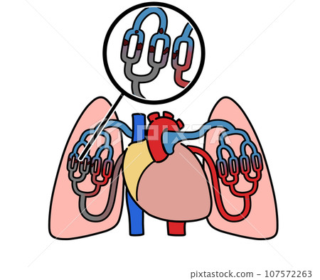 Pulmonary thromboembolism 107572263