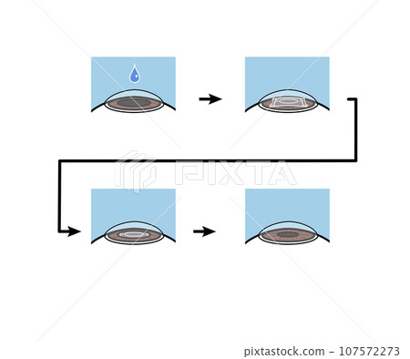 ICL（眼內隱形眼鏡）手術 107572273