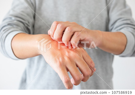 Young asian man itching and scratching on hand from itchy dry skin eczema dermatitis 107586919