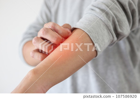 Young asian man itching and scratching on arm from itchy dry skin eczema dermatitis Young asian man itching and scratching on arm from itchy dry skin eczema dermatitis 107586920