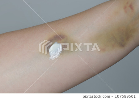 Medical ointment or cream on skin closeup Medical ointment or cream on skin closeup 107589501