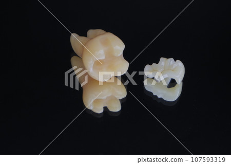 下臼齒陶瓷嵌體 107593319