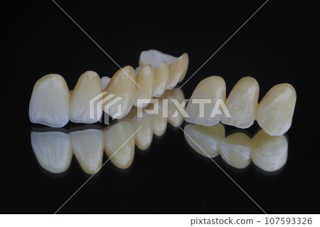 all ceramic crown bridge 107593326