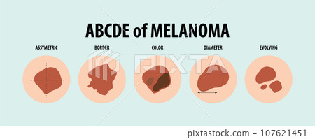 Illustrated Guide to Five Types of Skin Cancer 107621451