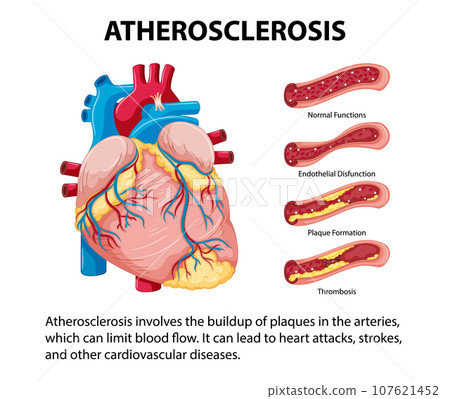 Science Education: Human Anatomy and Atherosclerosis Infographic 107621452