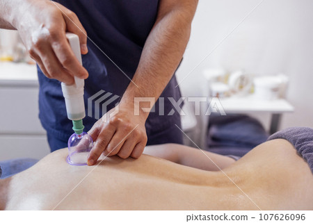 Close up of the male hands of the masseur putting vacuum plastic healing cans on the back of his female client. 107626096