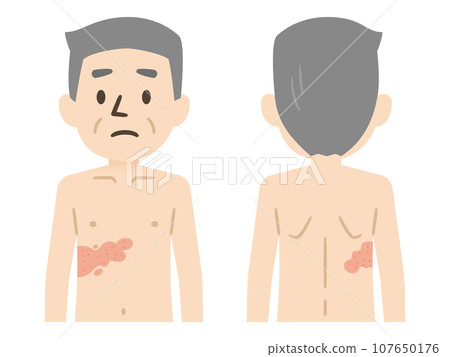 Shingles symptoms illustration Shingles symptoms illustration 107650176