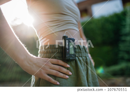 Close up of diabetic woman with insulin pump. Young woman with diabetes outdoors. 107670551