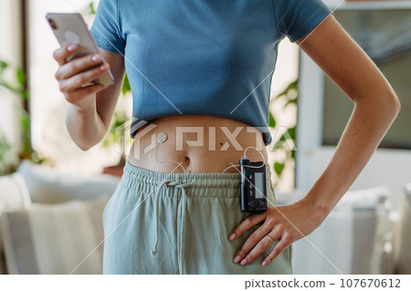 Close up of diabetic woman with insulin pump. Young woman with diabetes at home. 107670612