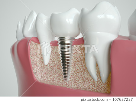 Implant Integration in Jaw Anatomy Visualization - 3D Rendering 107687257