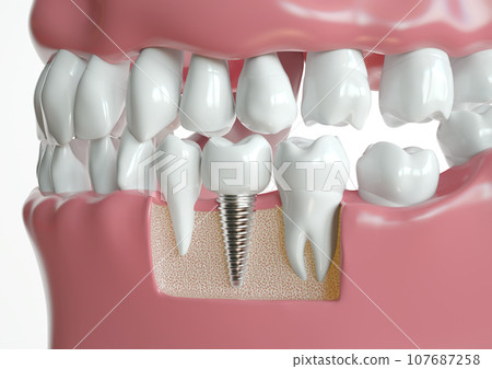 Implant Integration in Jaw Anatomy Visualization - 3D Rendering 107687258