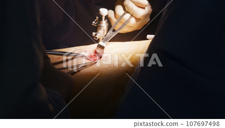 Surgeon operates patient using modern laparoscopic instruments Surgeon operates patient using modern laparoscopic instruments 107697498