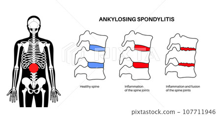 Ankylosing spondylitis disease Ankylosing spondylitis disease 107711946