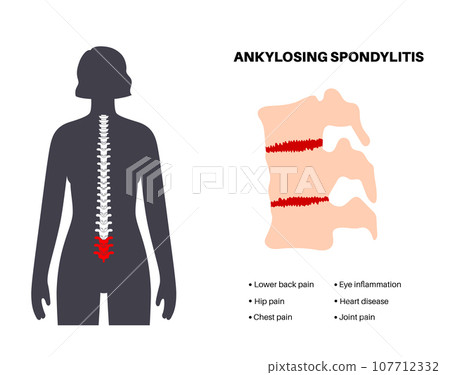 Ankylosing spondylitis disease 107712332
