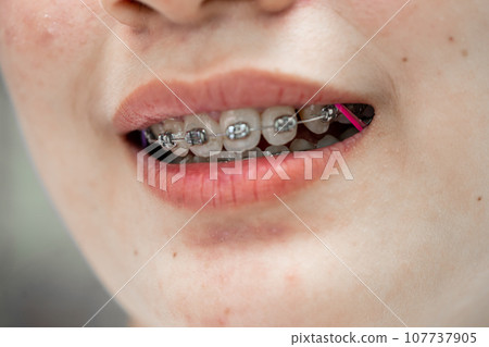 Braces in teenage girl mouth to treat and beauty for increase confidence and good personality. Braces in teenage girl mouth to treat and beauty for increase confidence and good personality. 107737905