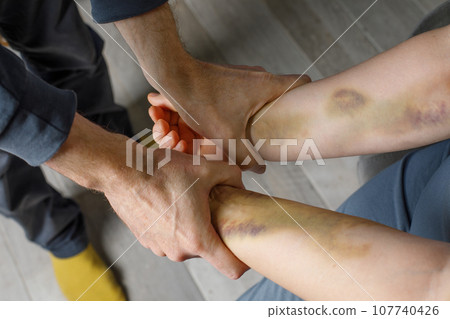 Domestic violence and abuse concept. Male hand and female hand with bruise at home 107740426
