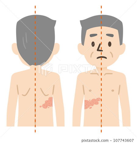 Shingles symptoms illustration 107743607