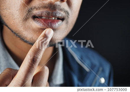 Close up of a young men hand dry lips  107753000
