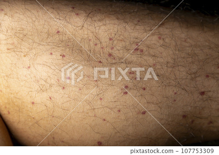Vasculitis. Vasculitis in legs. Small red or purple spots. Post covid syndrome due to an immunological reaction of the body. Grain. Inflammation of the blood vessels. Rare disease. Photography. Vasculitis. Vasculitis in legs. Small red or purple spots. Post covid syndrome due to an immunological reaction of the body. Grain. Inflammation of the blood vessels. Rare disease. Photography. 107753309