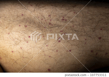 Vasculitis. Vasculitis in legs. Small red or purple spots. Post covid syndrome due to an immunological reaction of the body. Grain. Inflammation of the blood vessels. Rare disease. Photography. 107753311