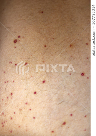 Vasculitis. Vasculitis in legs. Small red or purple spots. Post covid syndrome due to an immunological reaction of the body. Grain. Inflammation of the blood vessels. Rare disease. Photography. Vasculitis. Vasculitis in legs. Small red or purple spots. Post covid syndrome due to an immunological reaction of the body. Grain. Inflammation of the blood vessels. Rare disease. Photography. 107753314