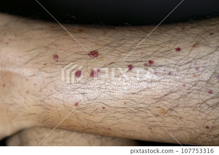 Vasculitis. Vasculitis in legs. Small red or purple spots. Post covid syndrome due to an immunological reaction of the body. Grain. Inflammation of the blood vessels. Rare disease. Photography. Vasculitis. Vasculitis in legs. Small red or purple spots. Post covid syndrome due to an immunological reaction of the body. Grain. Inflammation of the blood vessels. Rare disease. Photography. 107753316