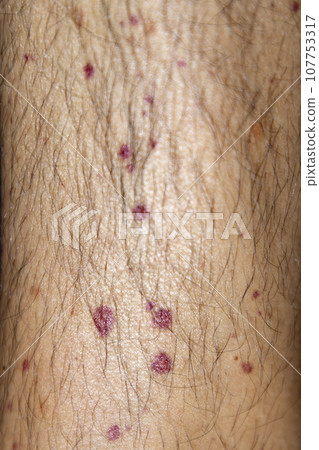 Vasculitis. Vasculitis in legs. Small red or purple spots. Post covid syndrome due to an immunological reaction of the body. Grain. Inflammation of the blood vessels. Rare disease. Photography. Vasculitis. Vasculitis in legs. Small red or purple spots. Post covid syndrome due to an immunological reaction of the body. Grain. Inflammation of the blood vessels. Rare disease. Photography. 107753317