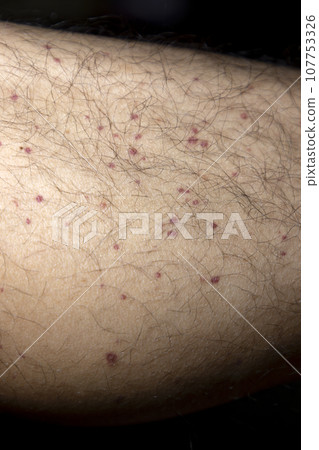 Vasculitis. Vasculitis in legs. Small red or purple spots. Post covid syndrome due to an immunological reaction of the body. Grain. Inflammation of the blood vessels. Rare disease. Photography. Vasculitis. Vasculitis in legs. Small red or purple spots. Post covid syndrome due to an immunological reaction of the body. Grain. Inflammation of the blood vessels. Rare disease. Photography. 107753326