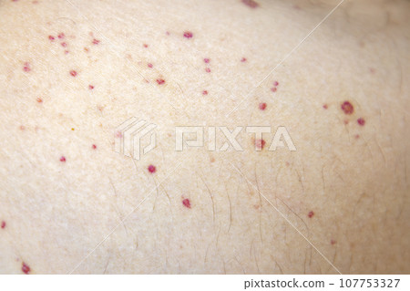Vasculitis. Vasculitis in legs. Small red or purple spots. Post covid syndrome due to an immunological reaction of the body. Grain. Inflammation of the blood vessels. Rare disease. Photography. 107753327