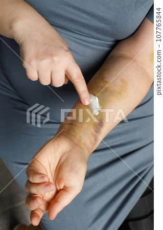 Close up photo of woman's hand is applying medical cream at bruise damage on arm. Close up photo of woman's hand is applying medical cream at bruise damage on arm. 107765844