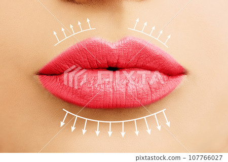 Bright female lips. Woman lips filler injectionsand lip augmentation 107766027