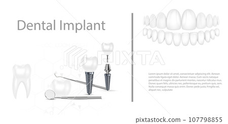 Dental implant structure medical pictorial educative infographic poster with molar replacement end healthy tools models vector illustration. 107798855