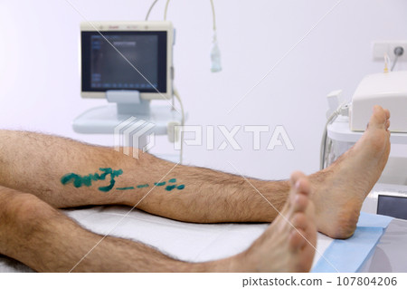 Medical surgery for endovenous laser photocoagulation of the great saphenous vein. Miniphlegectomy. Endovenous laser coagulation vein. 107804206