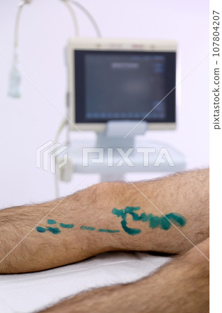 Medical surgery for endovenous laser photocoagulation of the great saphenous vein. Miniphlegectomy. Endovenous laser coagulation vein. 107804207