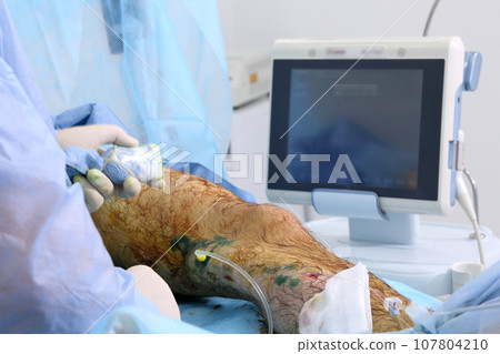 Medical surgery for endovenous laser photocoagulation of the great saphenous vein. Miniphlegectomy. Endovenous laser coagulation vein. 107804210