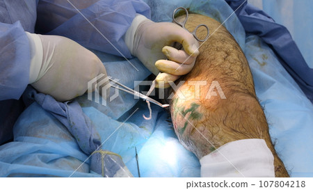 Medical surgery for endovenous laser photocoagulation of the great saphenous vein. Miniphlegectomy. Endovenous laser coagulation vein. Medical surgery for endovenous laser photocoagulation of the great saphenous vein. Miniphlegectomy. Endovenous laser coagulation vein. 107804218