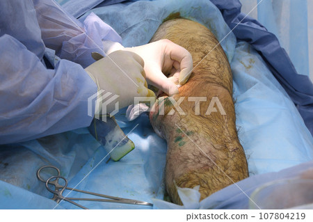 Medical surgery for endovenous laser photocoagulation of the great saphenous vein. Miniphlegectomy. Endovenous laser coagulation vein. Medical surgery for endovenous laser photocoagulation of the great saphenous vein. Miniphlegectomy. Endovenous laser coagulation vein. 107804219