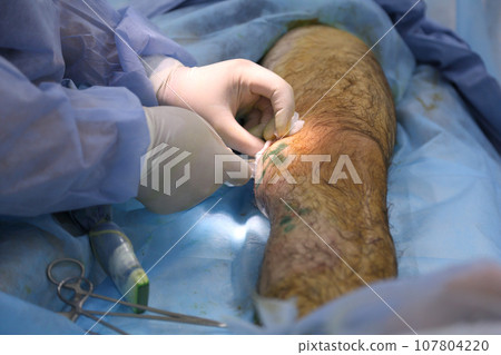 Medical surgery for endovenous laser photocoagulation of the great saphenous vein. Miniphlegectomy. Endovenous laser coagulation vein. Medical surgery for endovenous laser photocoagulation of the great saphenous vein. Miniphlegectomy. Endovenous laser coagulation vein. 107804220