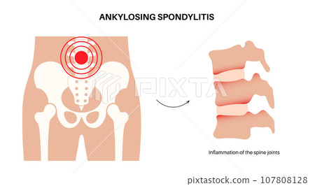 Ankylosing spondylitis disease 107808128