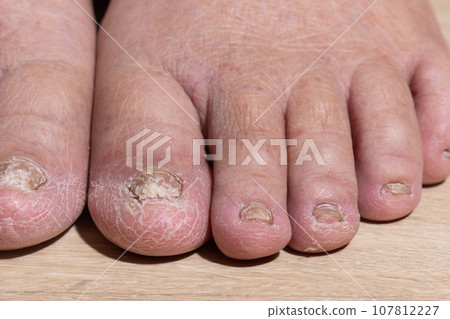 Cancer chemotherapy cause swelling of ankles (ankle oedema) , . skin to become dry, dark or peel and nails brittle or flaky. Cancer chemotherapy cause swelling of ankles (ankle oedema) , . skin to become dry, dark or peel and nails brittle or flaky. 107812227