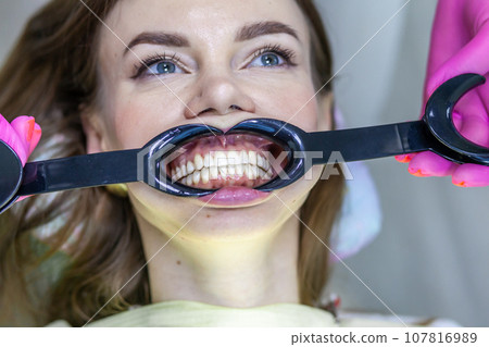 The process of removing braces. Beautiful woman with a mouth expander in a dental chair during the procedure of removing braces from her teeth. A dentist and an assistant work. 107816989