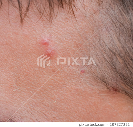 Pimples on the forehead of man. Acne on the forehead 107827251